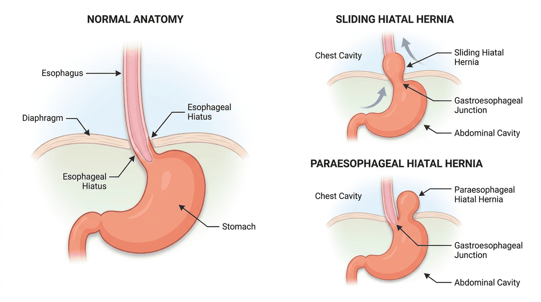 Hiatal hernia types: normal anatomy, sliding hiatal hernia, and paraesophageal hiatal hernia