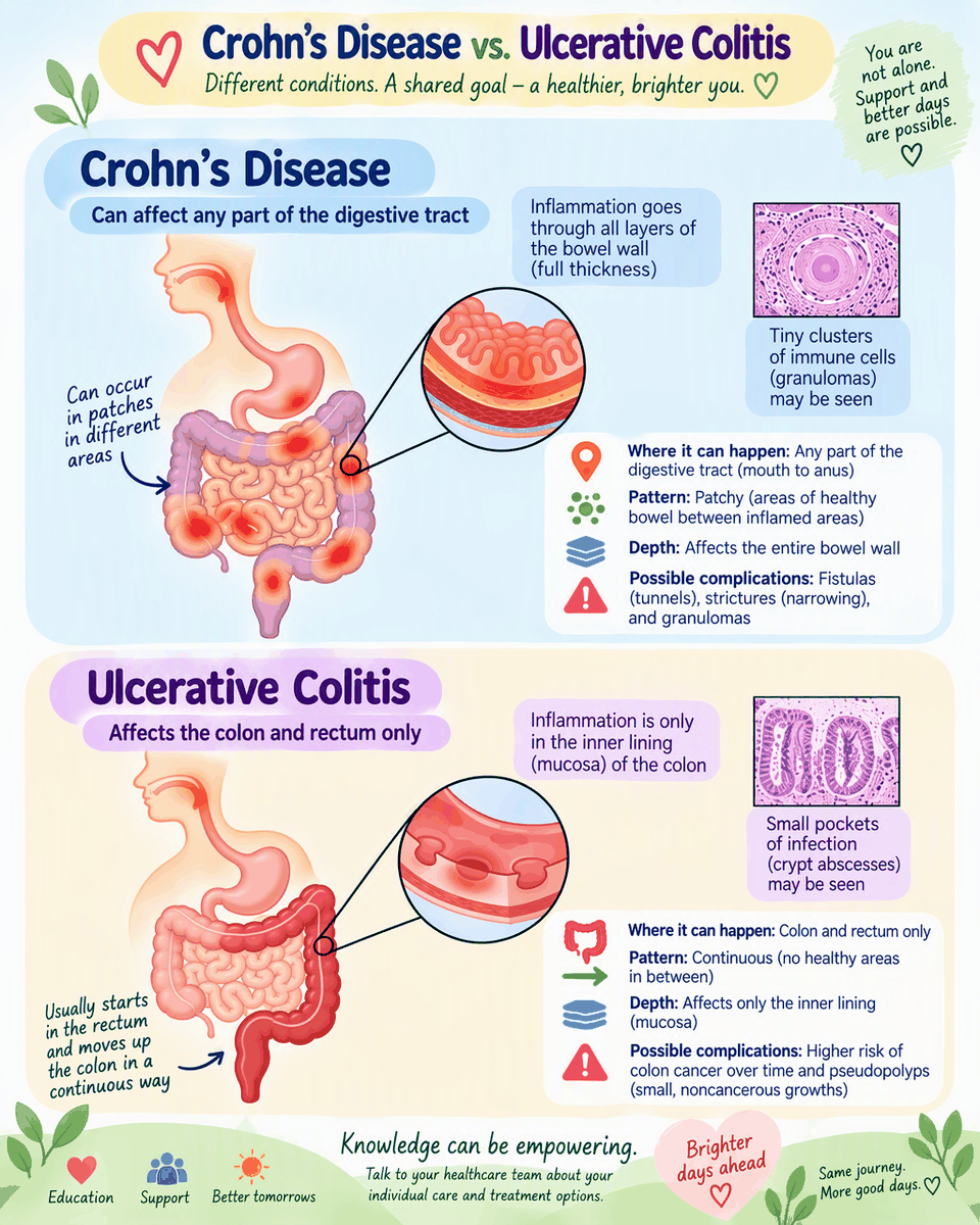 Crohn's disease vs ulcerative colitis: where each occurs, pattern, depth of inflammation, and complications