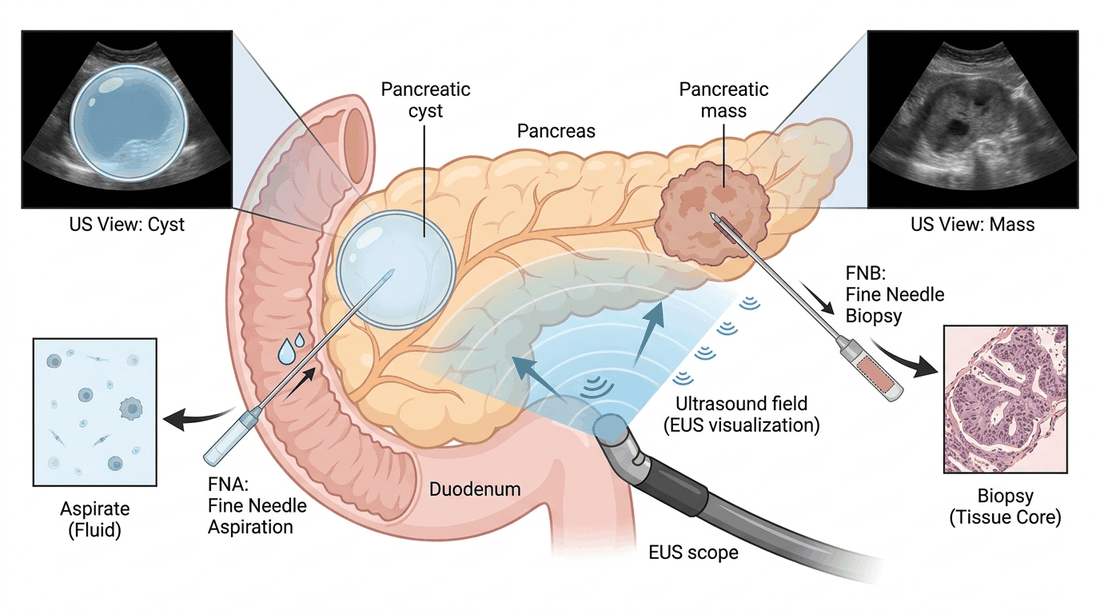 Endoscopic ultrasound of the pancreas with fine-needle aspiration of a cyst and fine-needle biopsy of a mass